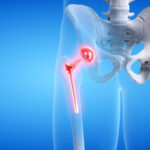 Hip Replacement