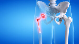 Hip Replacement